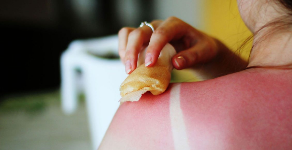 54ff792755635-soothe-sunburn-s2