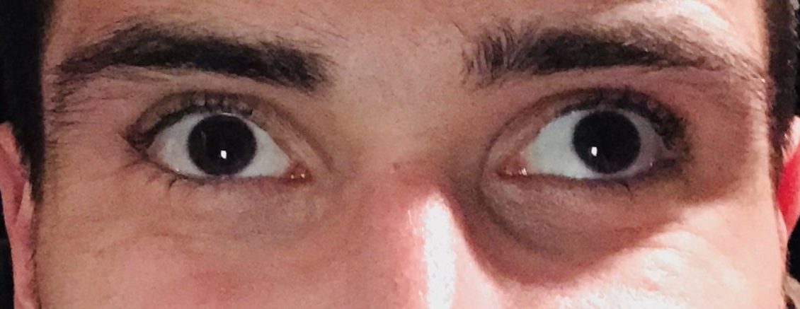 1200px-StrabismusVL2